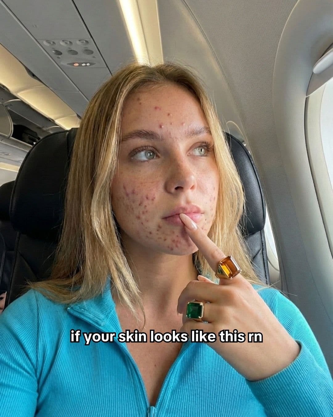 Slide one: a selfie taken in an airplane seat with visible facial breakouts and the text if your skin looks like this rn.